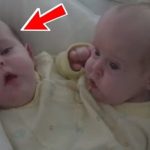 These conjoined twins were separated in 2006… Here’s how they live now!