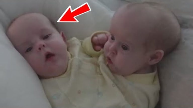 These conjoined twins were separated in 2006… Here’s how they live now!