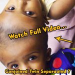 Can These Conjoined Twin Sisters Be Separated Safely? (Video)Can  ⬇️ 👇 full video in first comments below