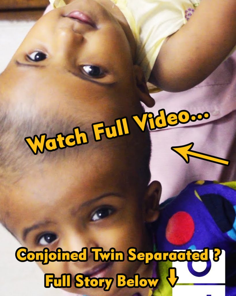 Can These Conjoined Twin Sisters Be Separated Safely? (Video)Can  ⬇️ 👇 full video in first comments below